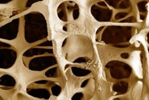 Osteoporosi