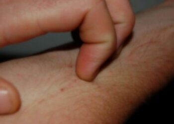 Due casi di scabbia alla ‘Don Bosco’ di Ciro’ Marina