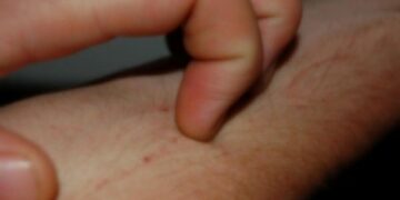 Due casi di scabbia alla ‘Don Bosco’ di Ciro’ Marina