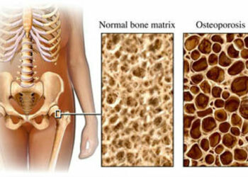 Torretta, giornata screening per l’osteoporosi