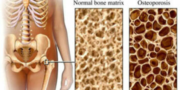 Torretta, giornata screening per l’osteoporosi
