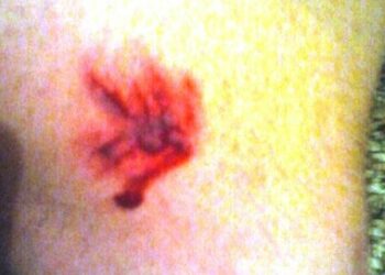 Quindicenne assalito e morso da tre cani randagi nel crotonese