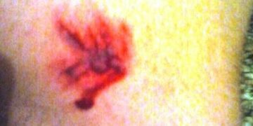 Quindicenne assalito e morso da tre cani randagi nel crotonese