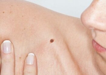 Prevenzione dermatologica a Crotone,150 screening a iniziativa Rotaract