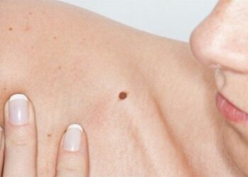Lotta ai tumori, a Crotone giornata di prevenzione del melanoma