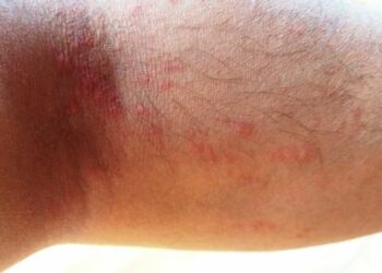 Ciro’, ustionati dalla segatura di una pianta