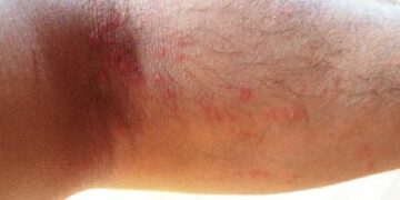 Ciro’, ustionati dalla segatura di una pianta