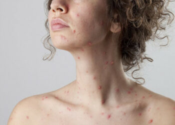 Germania: primo decesso per morbillo, il primo dal 2015