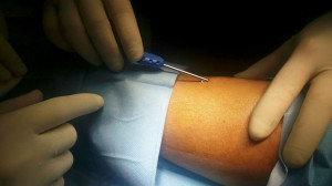 Lamezia Terme, Impiantato sensore per il monitoraggio della glicemia in tre giovani diabetici