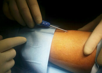 Lamezia Terme, Impiantato sensore per il monitoraggio della glicemia in tre giovani diabetici