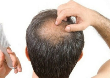 Addio (forse) per sempre alla calvizie, gli scienziati fermano la perdita di capelli