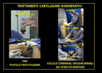 Anche a Cosenza si cura l’artrosi con le cellule staminali